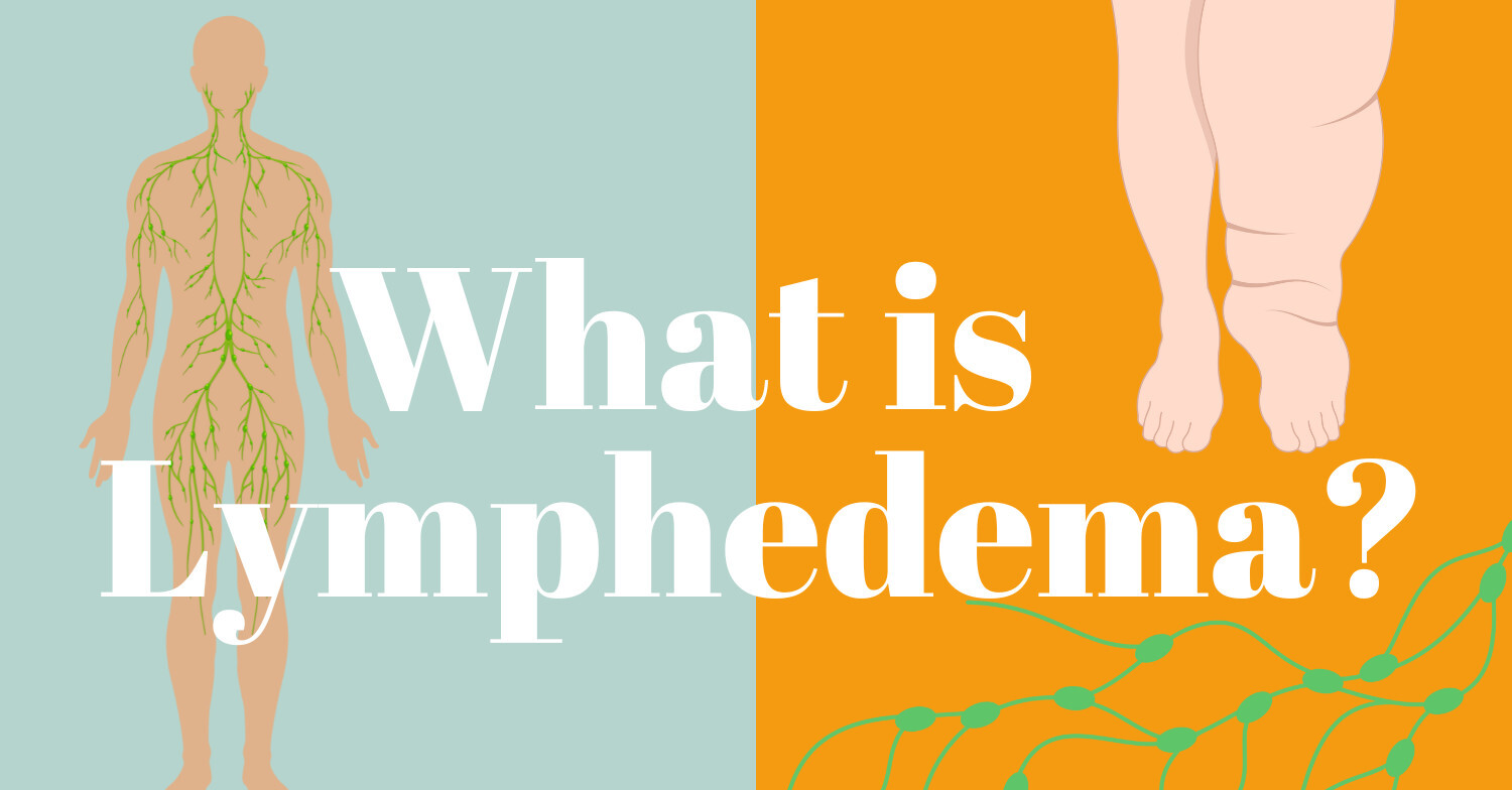 What is Lymphedema?